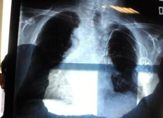 Cancro ai polmoni, individuato il punto debole: è nel ‘motore’ che lo fa crescere
