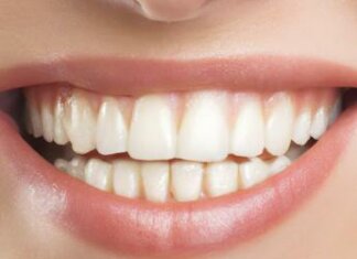 Sorriso ‘social’ perfetto e subito, è boom per le faccette sui denti anche a 14 anni