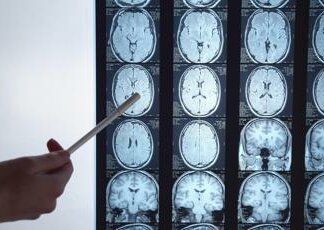 Calcio e ripetute commozioni cerebrali, neurologa: “Rischi a lungo termine”