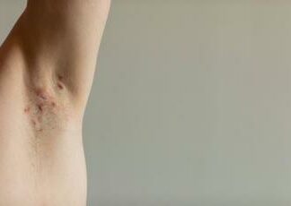 Farmaci, studi confermano efficacia monoclonale in idrosadenite suppurativa