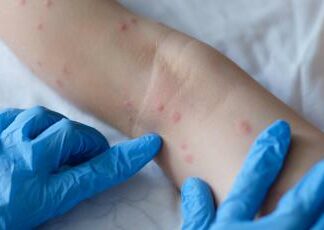 Tornano Open day dermatite atopica in 40 centri, campagna Sidemast