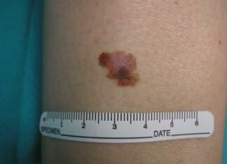 Cancro, oncologo: “Tre anni per vaccino mRna contro melanoma”