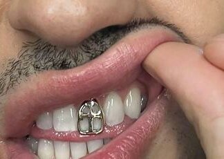 Gioielli sui denti, è grillz mania: possibili rischi
