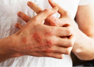 Psoriasi, dopo 4 anni di bimekizumab pazienti con skin clearance completa