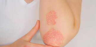 Giornata psoriasi, Ucb rinnova l’impegno contro lo stigma