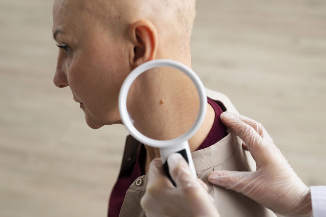 Melanoma dottrore