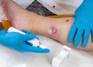 Idrosadenite suppurativa, le iniziative di Ucb per migliorare diagnosi e cura