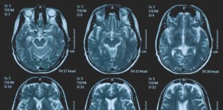 Tumori, glioma pediatrico di basso grado: via libera in Europa a prima terapia mirata