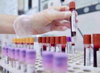 Sclerosi multipla recidivante, Ema raccomanda approvazione ocrelizumab dai 10 anni