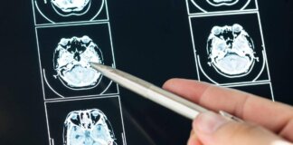 Ecco come il Long Covid cambia il cervello con meccanismi tipici dell’Alzheimer