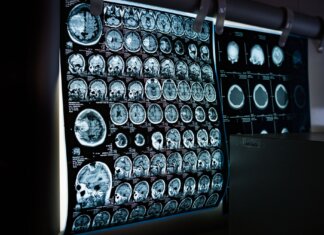 Leggere il pensiero con il suono, una startup sfida Neuralink di Musk con gli ultrasuoni