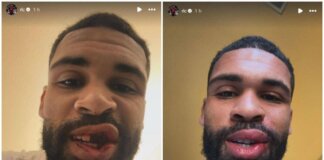 Loftus-Cheek, intervento riuscito alla mascella. E mostra foto dopo scontro in Milan-Parma