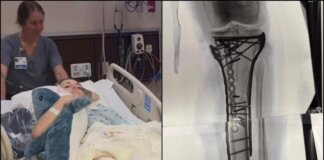 Milano Cortina, Vonn mostra la gamba dopo le operazioni: “Dolore difficile da gestire”