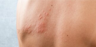 Vaccini: 1 over 50 su 2 con cronicità non parla col medico di Herpes Zoster