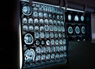 Cervello maschile e femminile: la differenza (sottile) è scritta nei geni