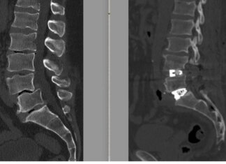 Chirurgia vertebrale complessa, al Tiberia Hospital di Roma intervento con tecnica Alif