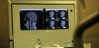 Sogni agitati sintomo Parkinson? Medici anti-bufale ‘può accadere, si fa polisonnografia’