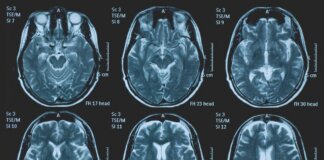 Una persona su 3 ha un disturbo neurologico, a Napoli arriva BrainSpace House