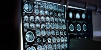 Uno spray nasale ferma l’invecchiamento del cervello, lo studio