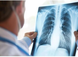 Cancro al polmone, approvato il rimborso di 2 nuove indicazioni per durvalumab