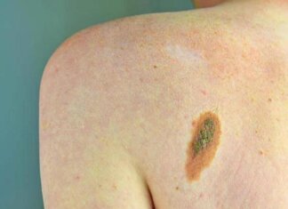 Imi: “Bene legge su prevenzione melanoma, educare i giovani su rischi”