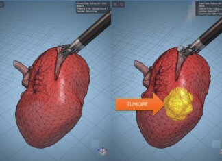 Modelli tridimensionali biomimetici del cancro al rene di un paziente per chirurgia robotica sempre più precisa