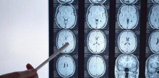 Di Battista e il tumore al cervello, in Italia circa 6mila diagnosi ogni anno: quali sono i sintomi ‘spia’