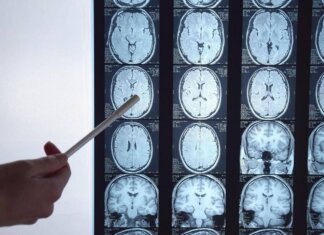 Di Battista e il tumore al cervello, in Italia circa 6mila diagnosi ogni anno: quali sono i sintomi ‘spia’