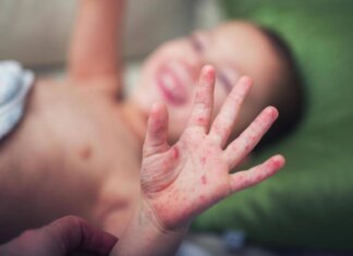 Morbillo, aumentano casi e ricoveri. Bassetti: “In Liguria focolaio senza precedenti, l’Italia rischia gravissima epidemia”