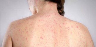 Morbillo, è allarme negli Usa. Italia prima per casi in Europa in in primi 6 mesi 2026