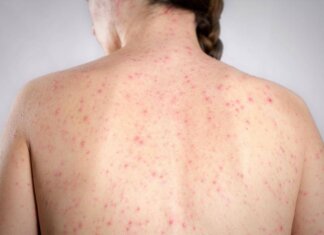 Morbillo, è allarme negli Usa. Italia prima per casi in Europa in in primi 6 mesi 2026