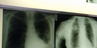 Cancro polmone, con nuova combinazione malattia sotto controllo più a lungo