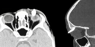 Ha un gonfiore sotto l’occhio, in ospedale scoprono che ha un dente nella palpebra: lo strano caso in India