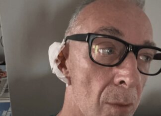 Linus ha una malattia della pelle: “Si chiama Epitelioma”. Di cosa si tratta