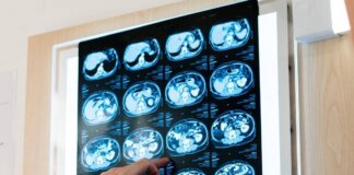 Nodulo polmonare: che cos’è, come si diagnostica e quando intervenire